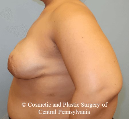 Breast Reconstruction After