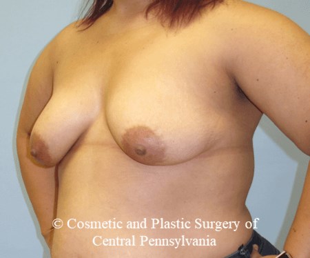 Breast Reconstruction Before
