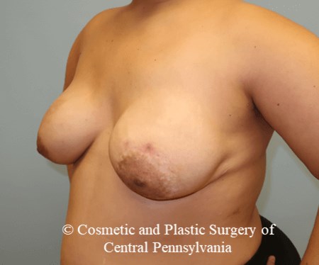 Breast Reconstruction After