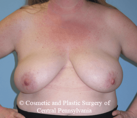 Breast Reconstruction Before