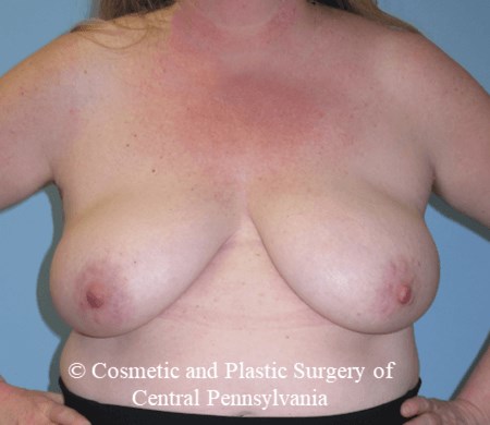 Breast Reconstruction Before
