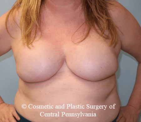 Breast Reconstruction After