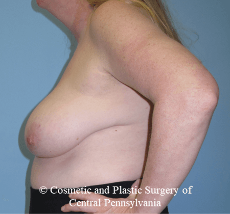 Breast Reconstruction Before