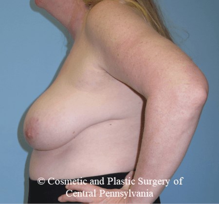 Breast Reconstruction Before