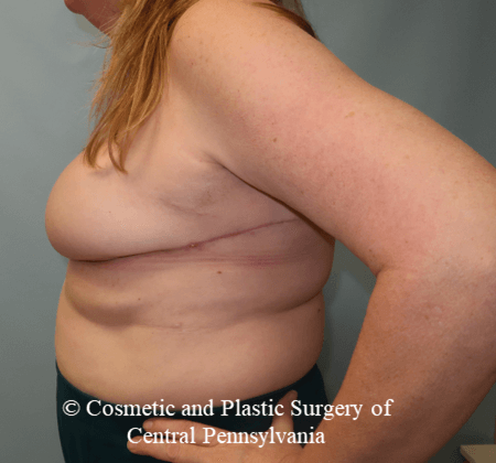 Breast Reconstruction After