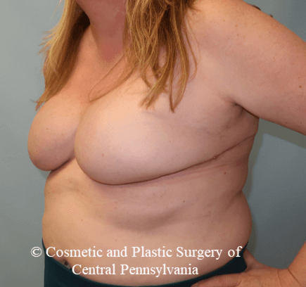 Breast Reconstruction After
