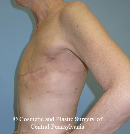 Latissimus Breast Recon Before