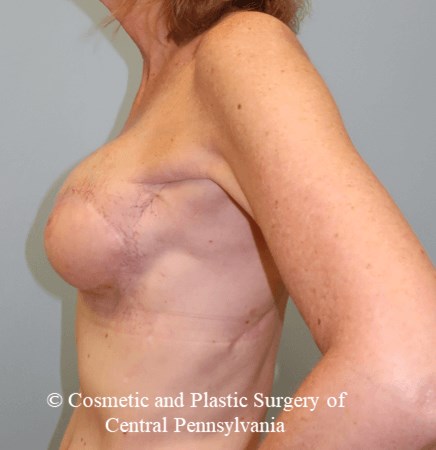 Latissimus Breast Recon After