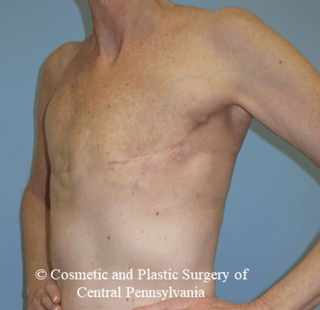 Latissimus Breast Recon Before