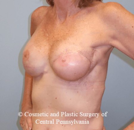 Latissimus Breast Recon After