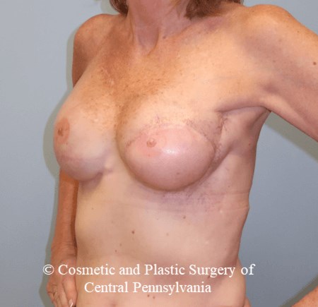 Latissimus Breast Recon After