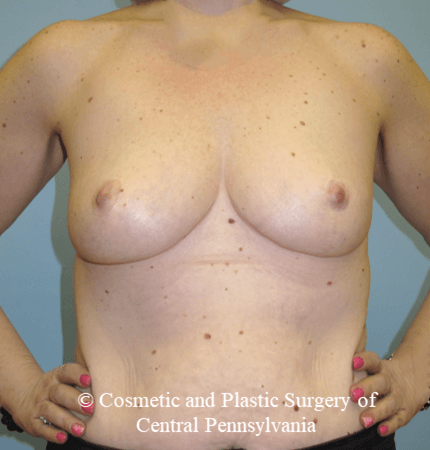 Breast Augmentation Before