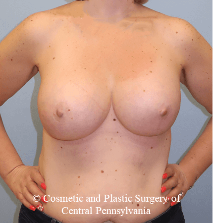 Breast Augmentation After
