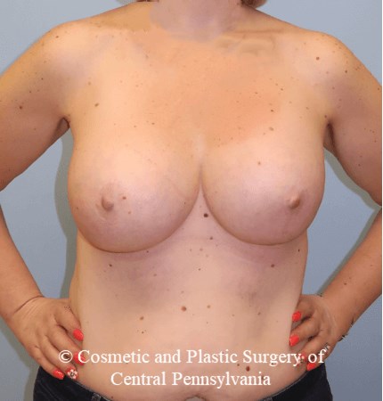 Breast Augmentation After
