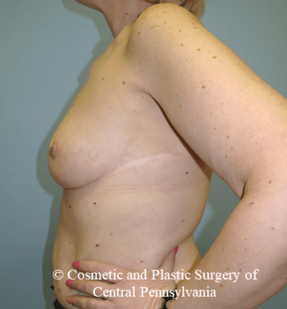 Breast Augmentation Before