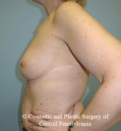 Breast Augmentation Before