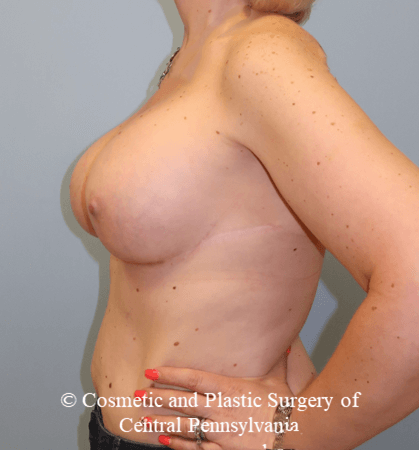 Breast Augmentation After
