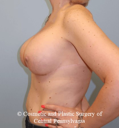 Breast Augmentation After