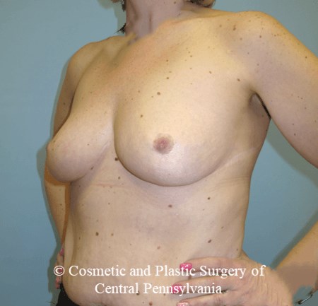 Breast Augmentation Before