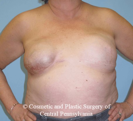 Breast Reconstruction Revision Before