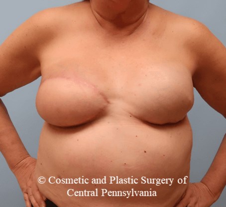 Breast Reconstruction Revision After
