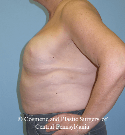 Breast Reconstruction Revision Before