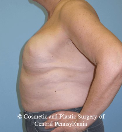 Breast Reconstruction Revision Before