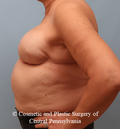 Breast Reconstruction Revision After