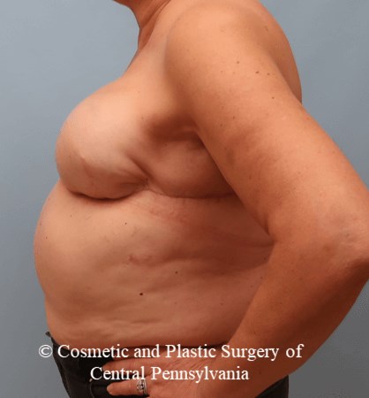 Breast Reconstruction Revision After