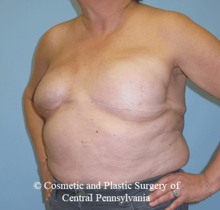 Breast Reconstruction Revision Before