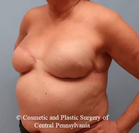 Breast Reconstruction Revision After