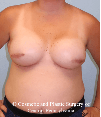Breast Reconstruction After