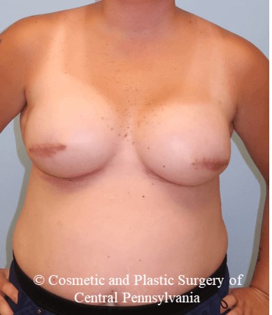 Breast Reconstruction After