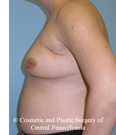 Breast Reconstruction Before