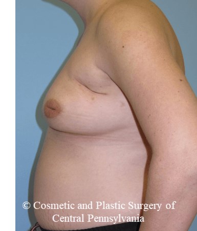 Breast Reconstruction Before