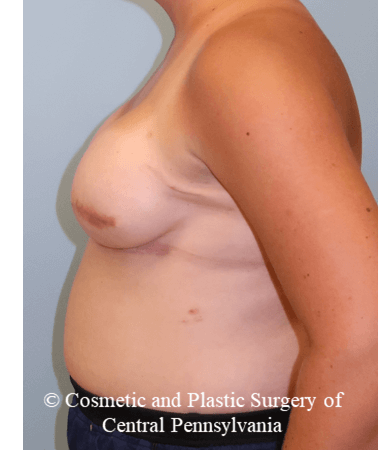 Breast Reconstruction After