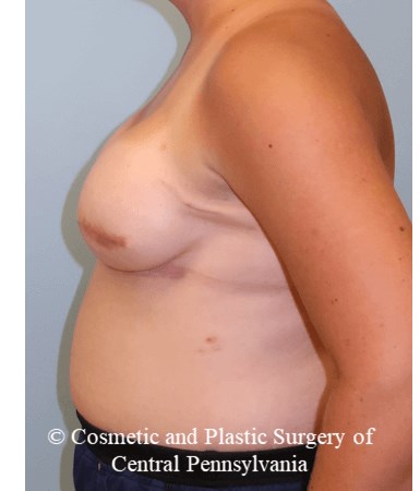 Breast Reconstruction After