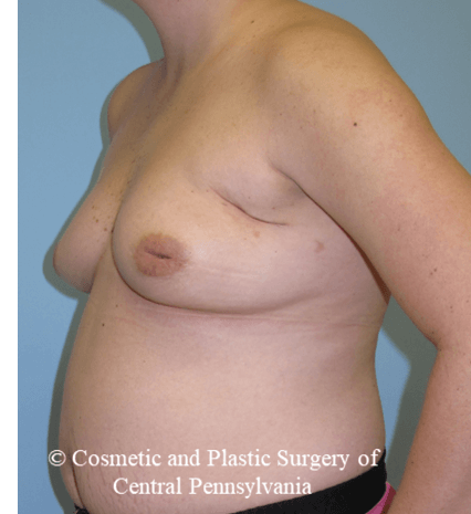 Breast Reconstruction Before