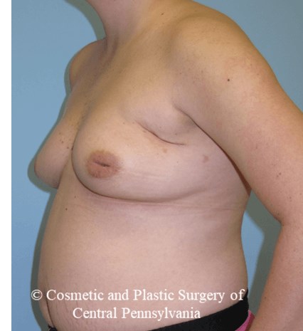 Breast Reconstruction Before