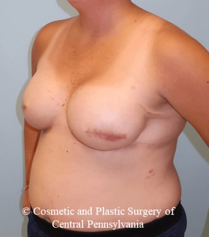 Breast Reconstruction After