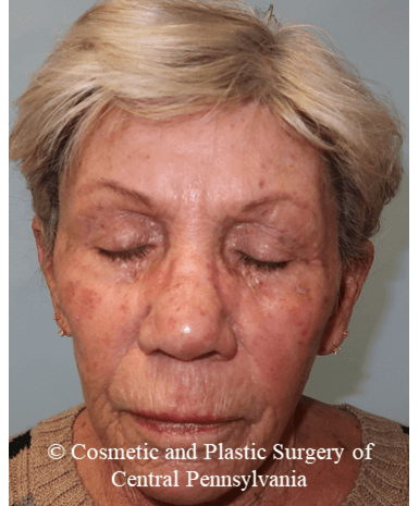 TCA 35% Chemical Peel Before