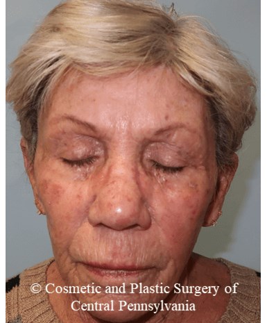 TCA 35% Chemical Peel Before