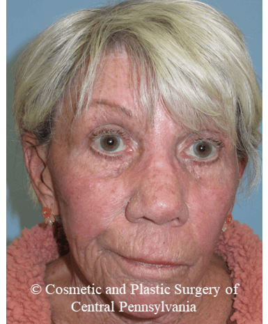 TCA 35% Chemical Peel After