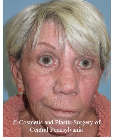 TCA 35% Chemical Peel After