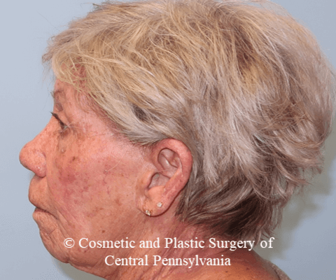 TCA 35% Chemical Peel Before