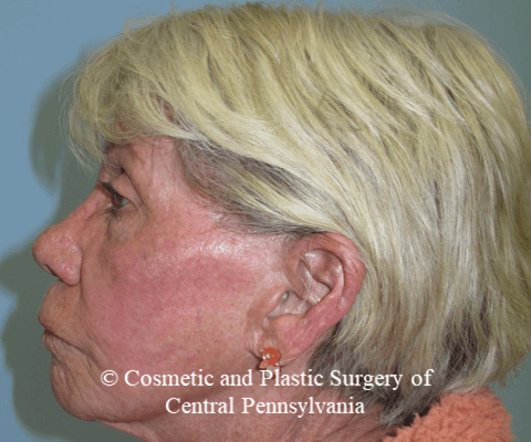 TCA 35% Chemical Peel After