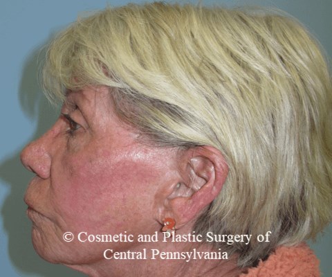 TCA 35% Chemical Peel After