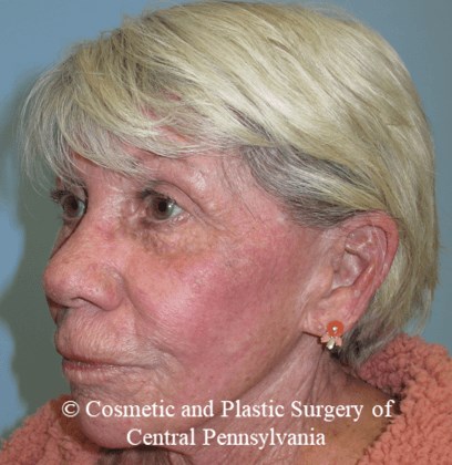 TCA 35% Chemical Peel After