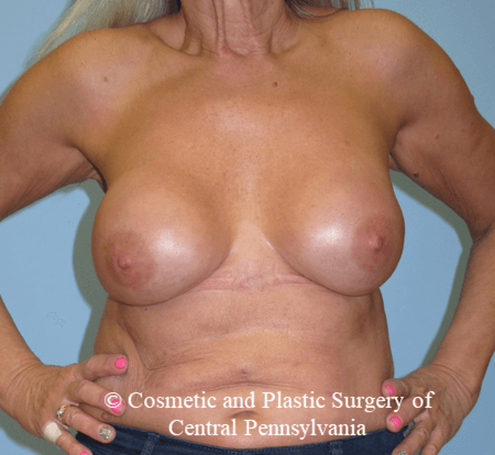 Breast Reconstruction After
