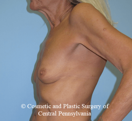 Breast Reconstruction Before